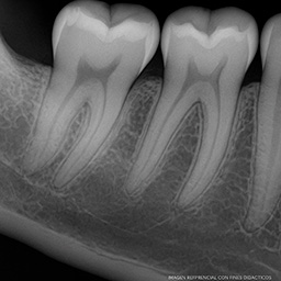 Ejemplo Radiografía Bitewing
