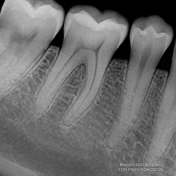 Ejemplo Radiografía Periapical